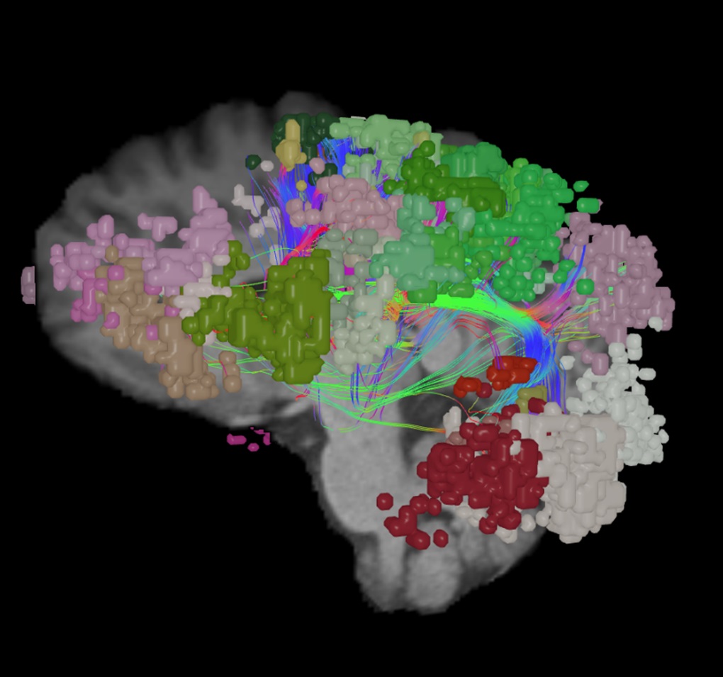 Imagen: La tecnología de mapeo cerebral QuickTome ofrece información rápida e intuitiva sobre las redes cerebrales de un paciente (Fotografía cortesía de o8t)